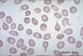 Tear Cells (Dacrocytes, Teardrops) – A Laboratory Guide to .